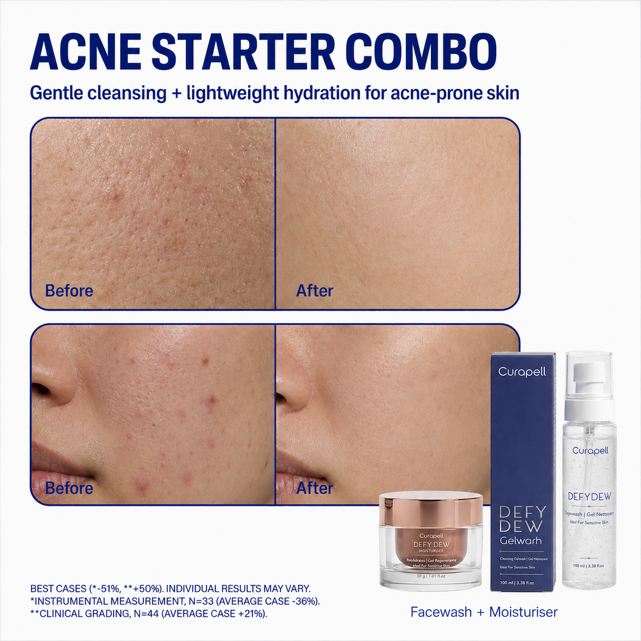 Acne Starter Combo