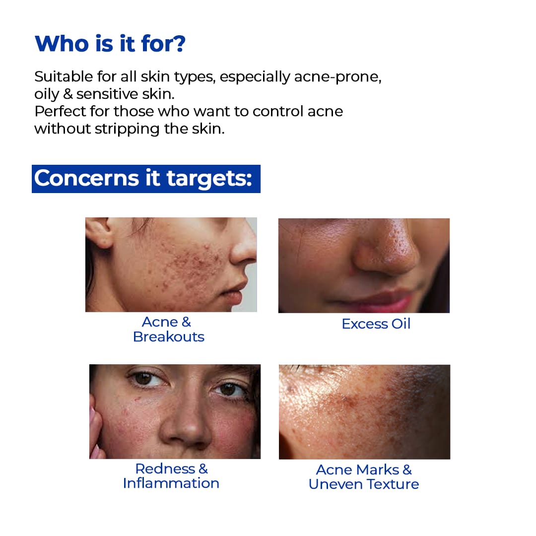 Acne Control Defy Dew Serum